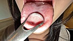【個人撮影】音羽美鈴の舌ブラシで「汚舌苔」採取 サンプル