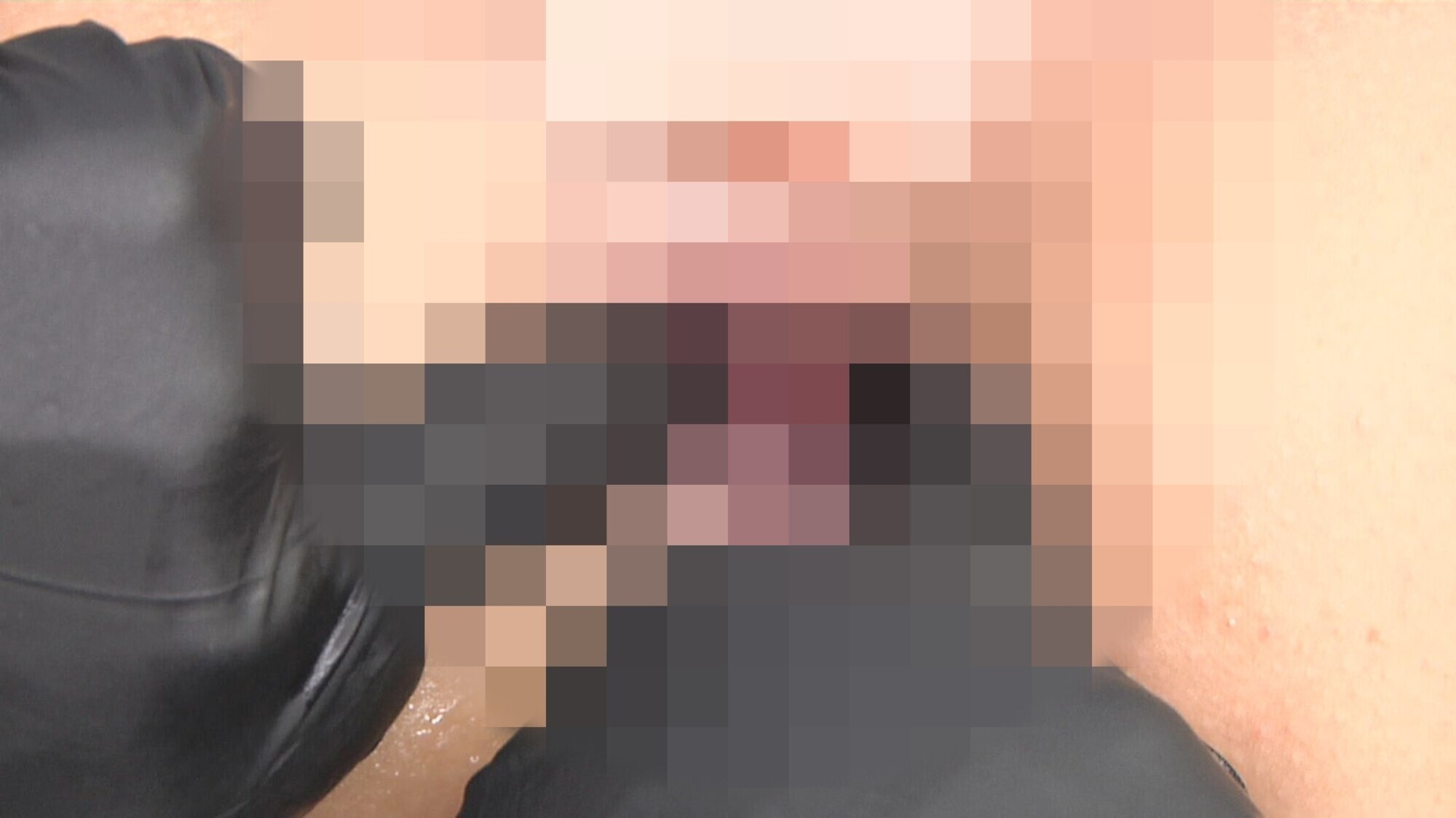 尻穴拡張クリニック 臨床手順に基づくアナル拡張記録