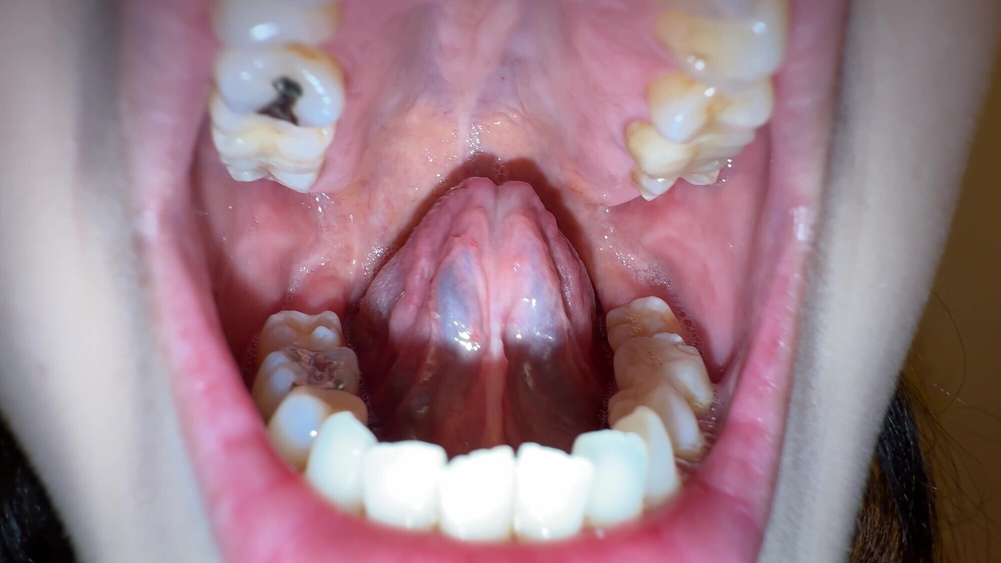 【個人撮影】横山夏希の舌ブラシで「汚舌苔」採取 画像3