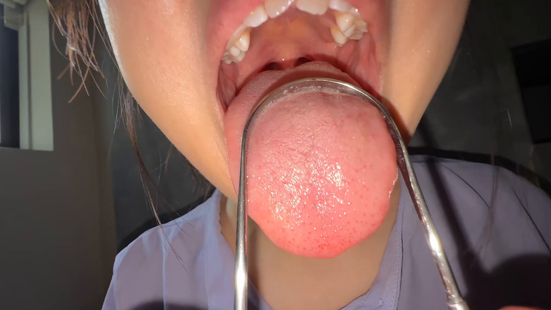 【個人撮影】谷田かりなの舌ブラシで「汚舌苔」採取 画像9
