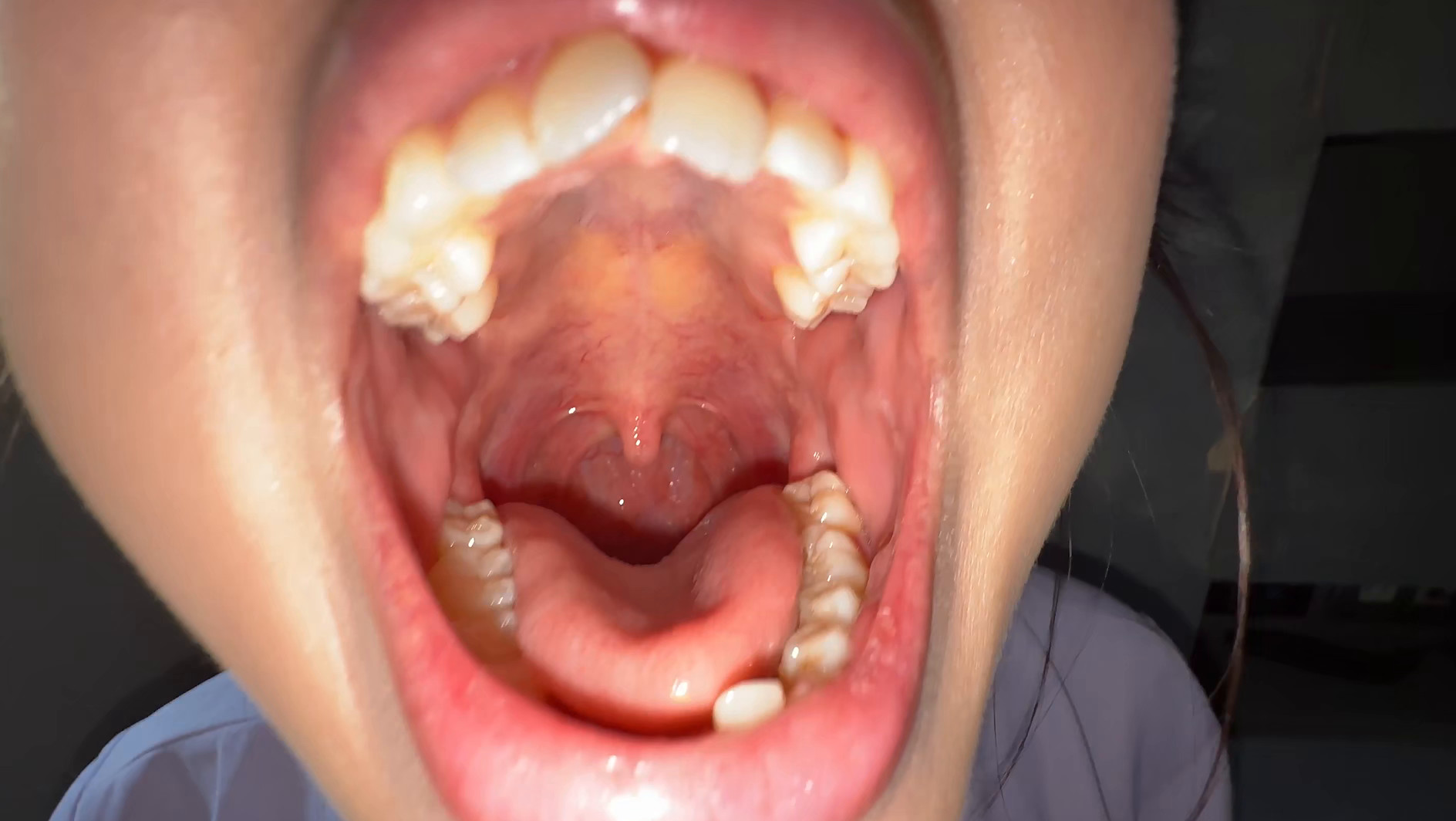 【個人撮影】谷田かりな 開口器で口内観察デカ舌を要チェック 画像2