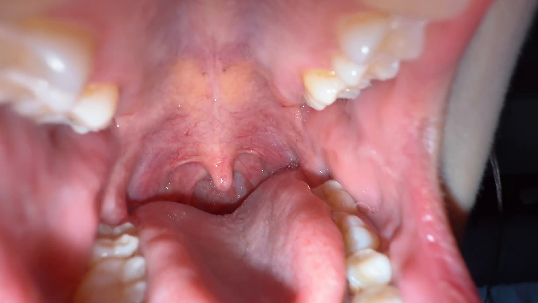 【個人撮影】谷田かりな 開口器で口内観察デカ舌を要チェック 画像4