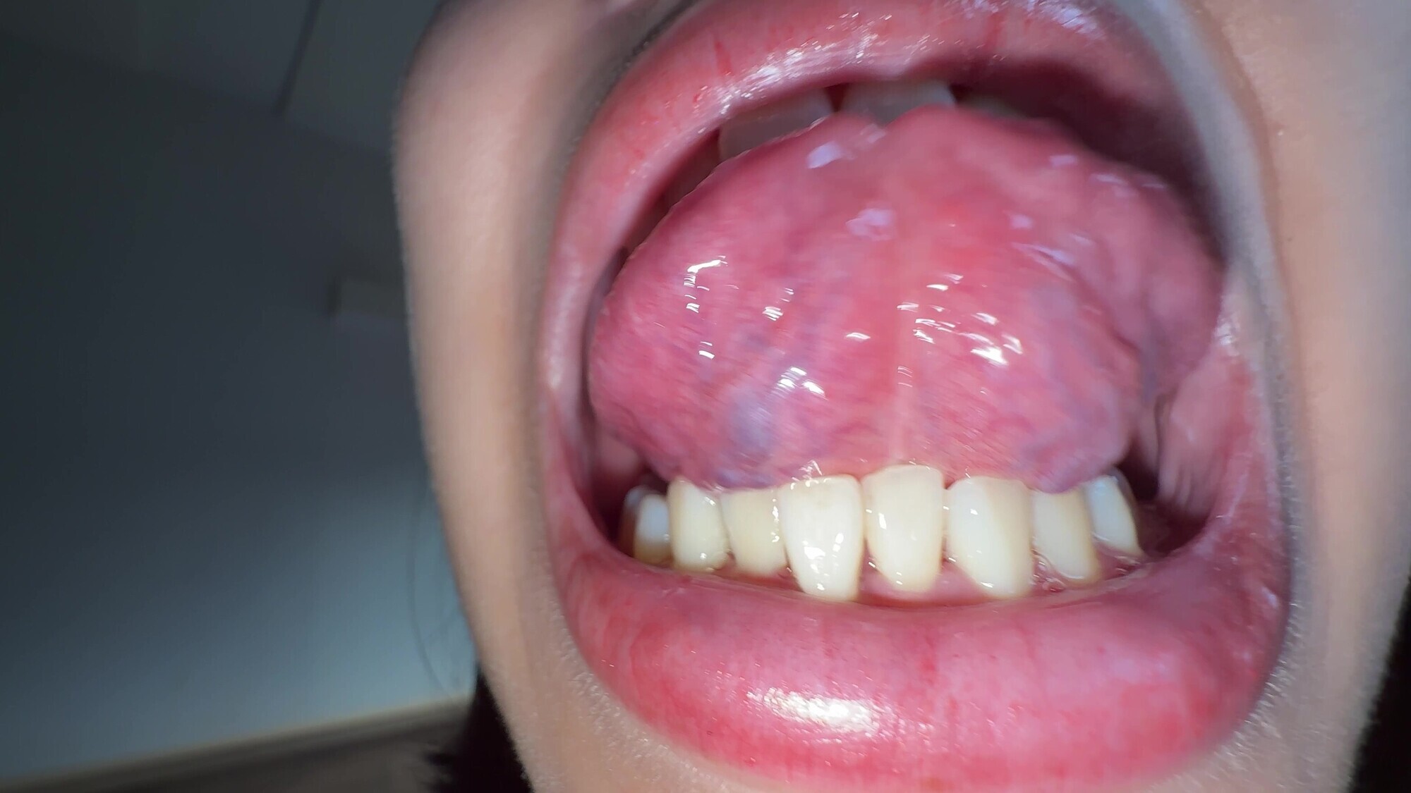 【個人撮影】湊波流の舌ブラシで「汚舌苔」採取！