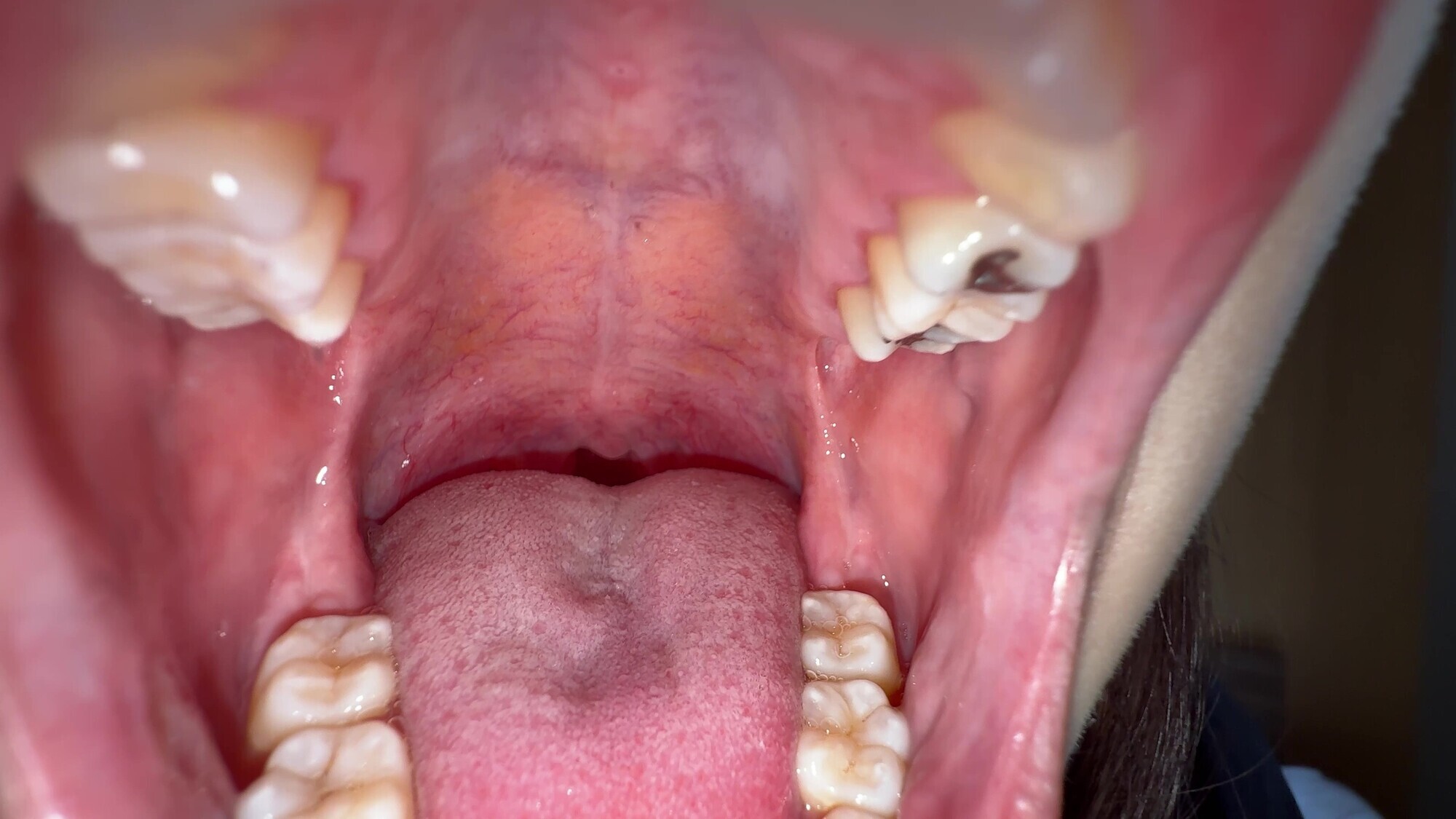 【個人撮影】湊波流の舌ブラシで「汚舌苔」採取！