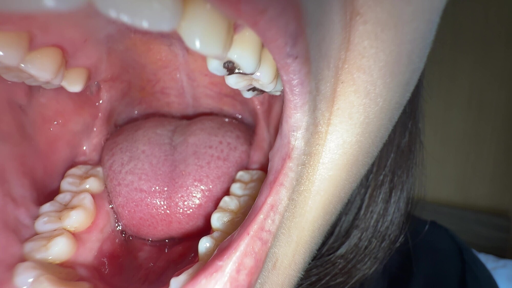 【個人撮影】湊波流の舌ブラシで「汚舌苔」採取！