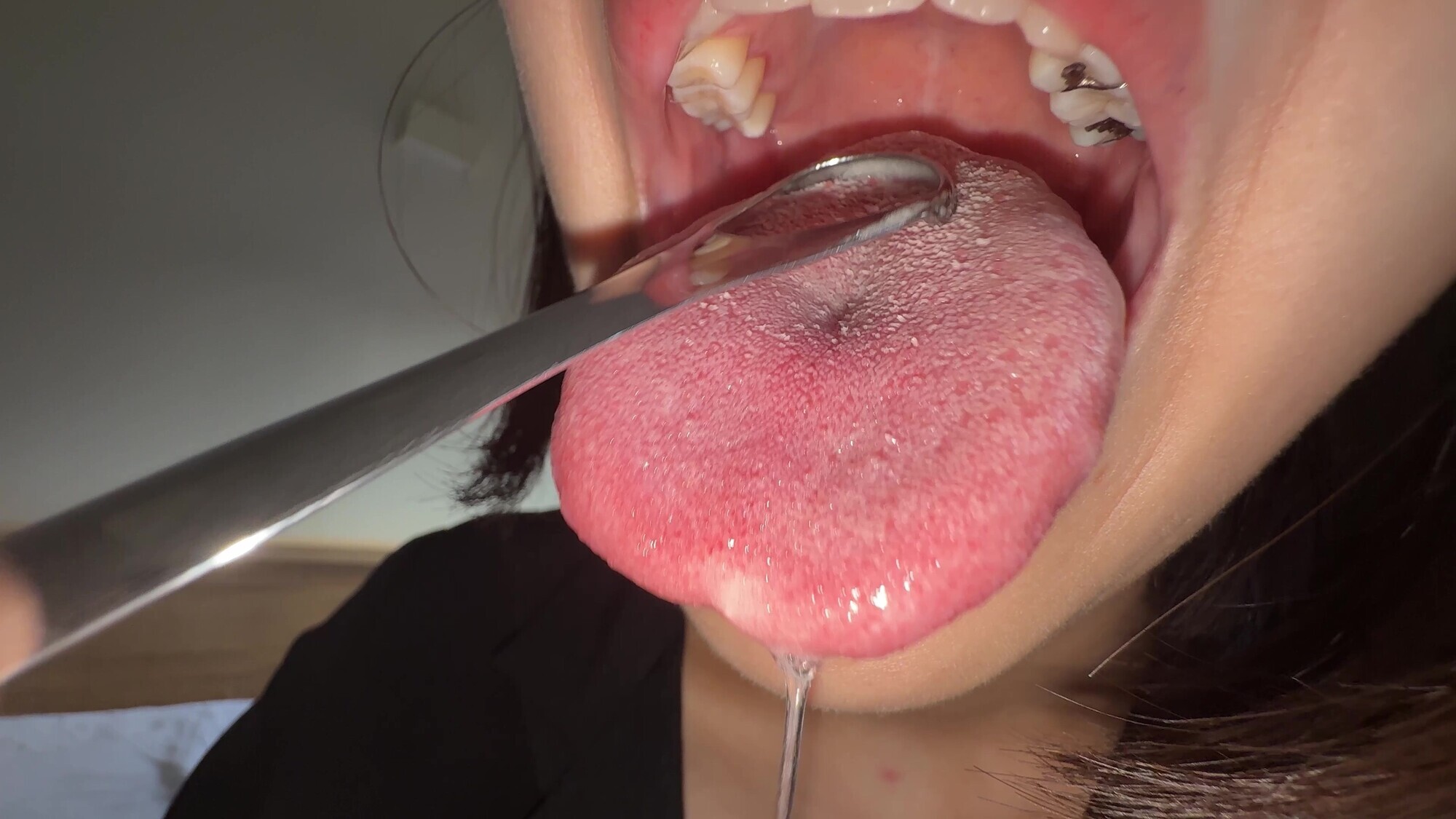 【個人撮影】湊波流の舌ブラシで「汚舌苔」採取！
